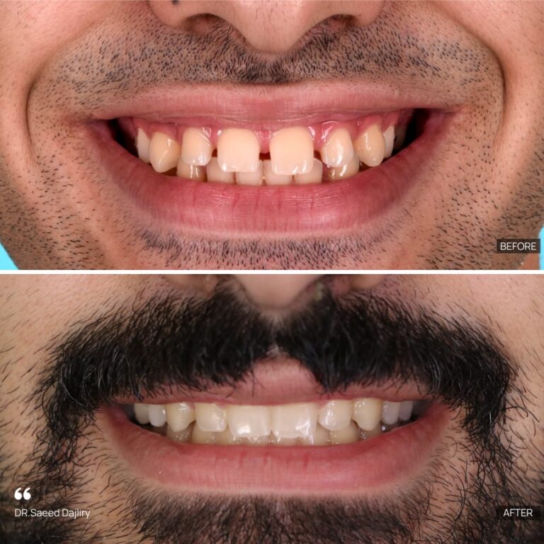 ارتودنسی با الاینر