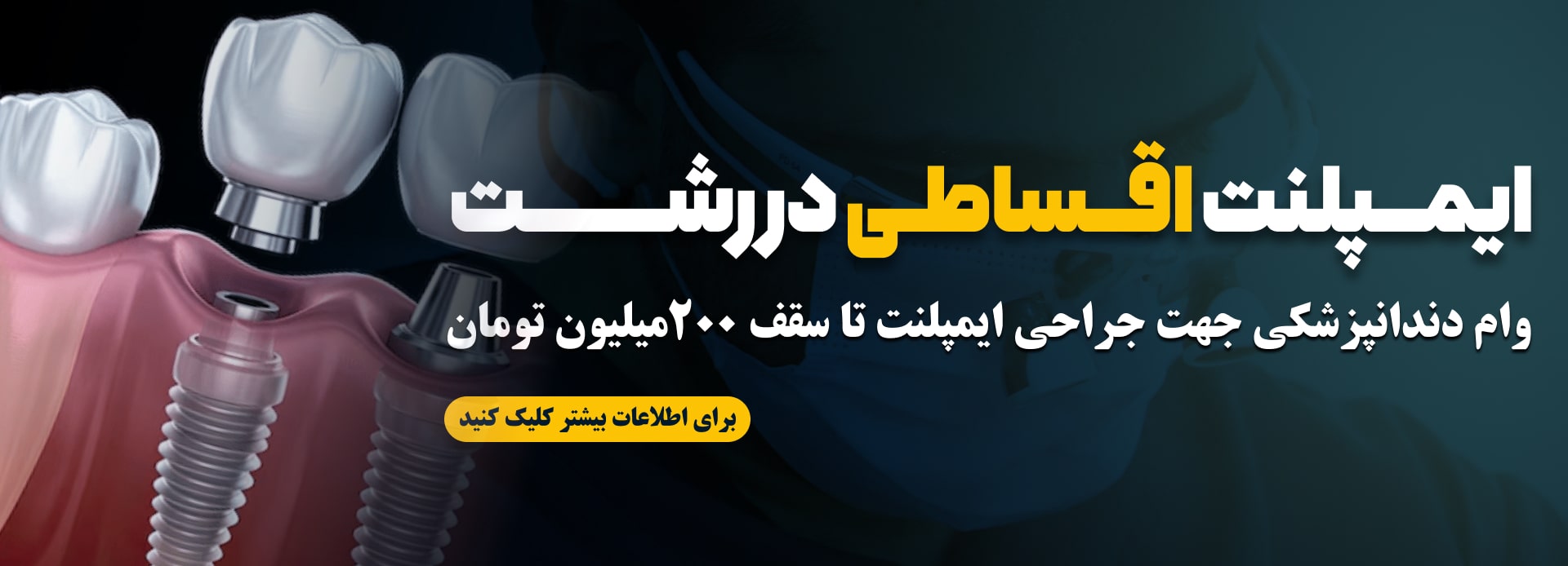 ایمپلنت اقساطی در رشت با وام 200 میلیونی