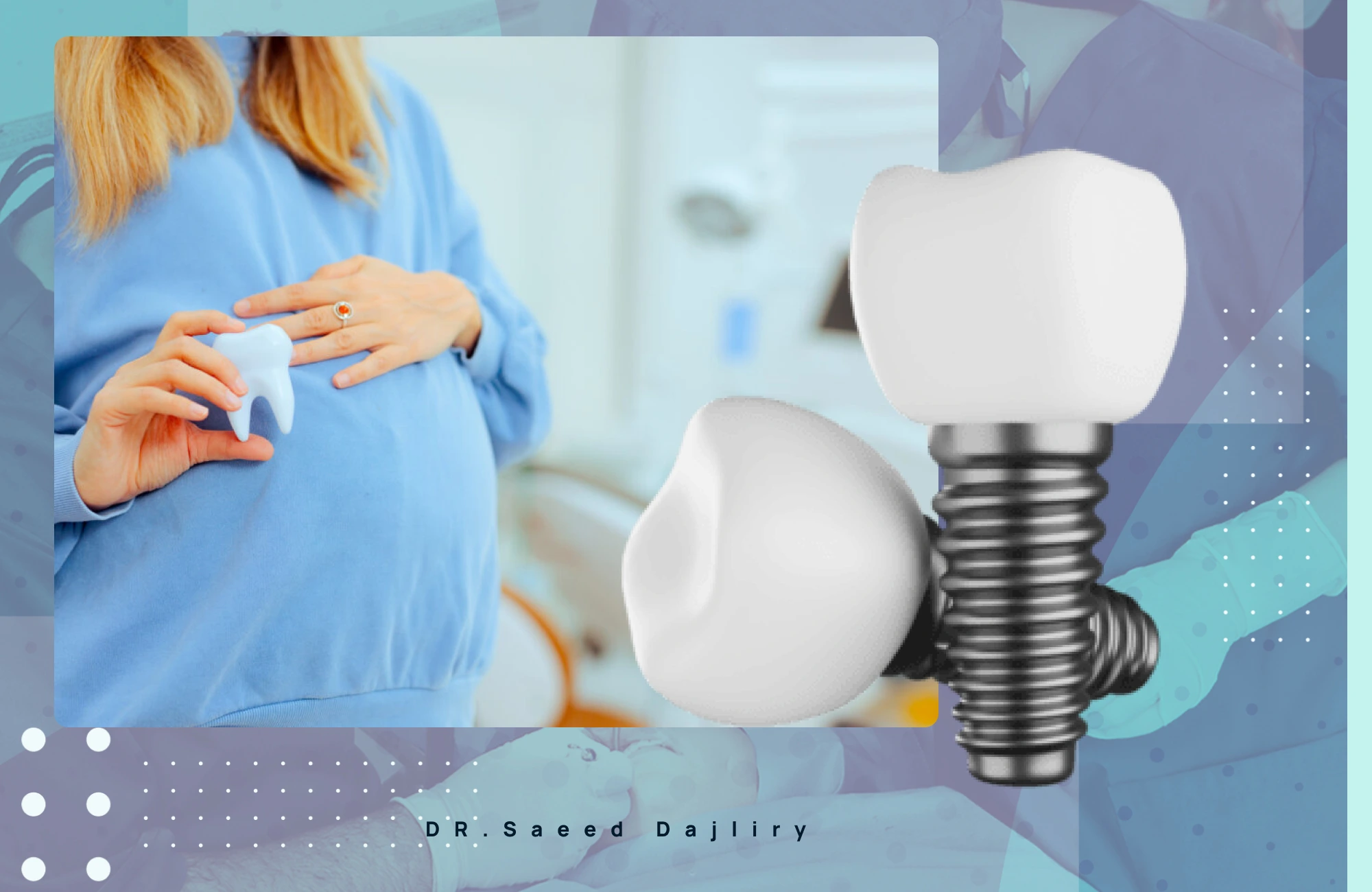 ایمپلنت دندان در بارداری