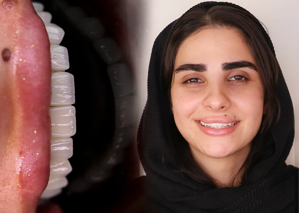 ماندگاری لمینت دندان